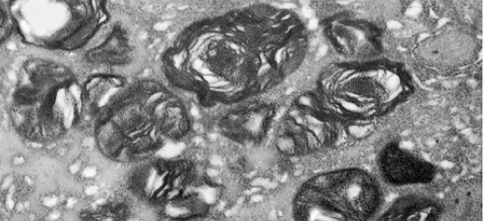 Laminated myelin sea blue histiocytes